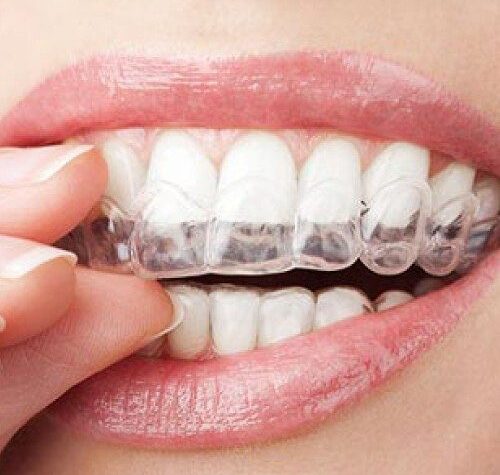 How To Make Your Dental Braces Last Longer